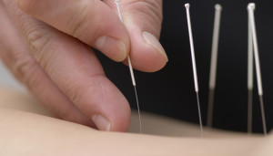 Acupuncture needles are much thinner and smaller than hypodermic needles - about a hair's width.